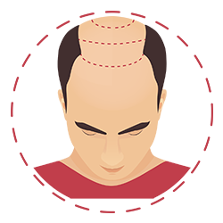 consultation and preparation for a hair transplant